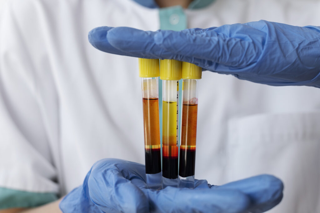 Blood in Urine Treatment